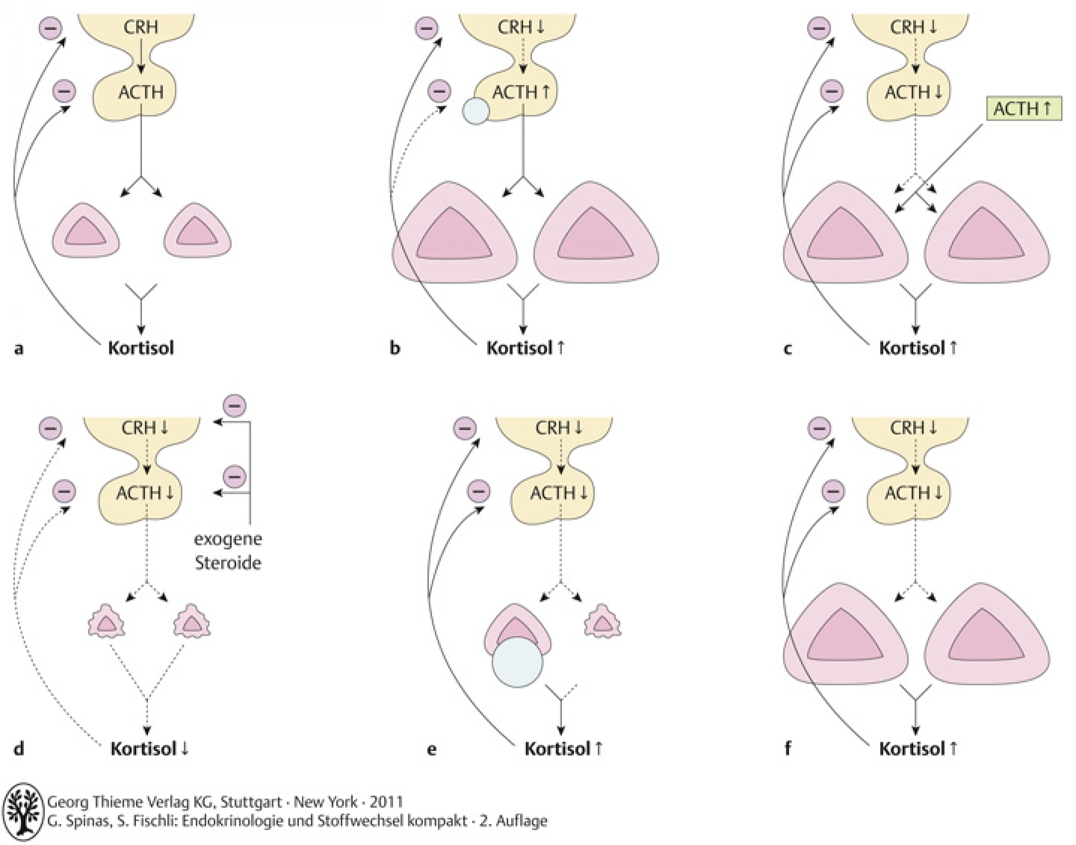 Pathogenese des Cushing-Syndroms. a normaler Regelkreis, b Morbus Cushing, c ektope ACTH-Produktion, d iatrogenes Cushing-Syndrom, e NNR-Neoplasie (meist Adenom), f bilaterale NNR-Hyperplasie
