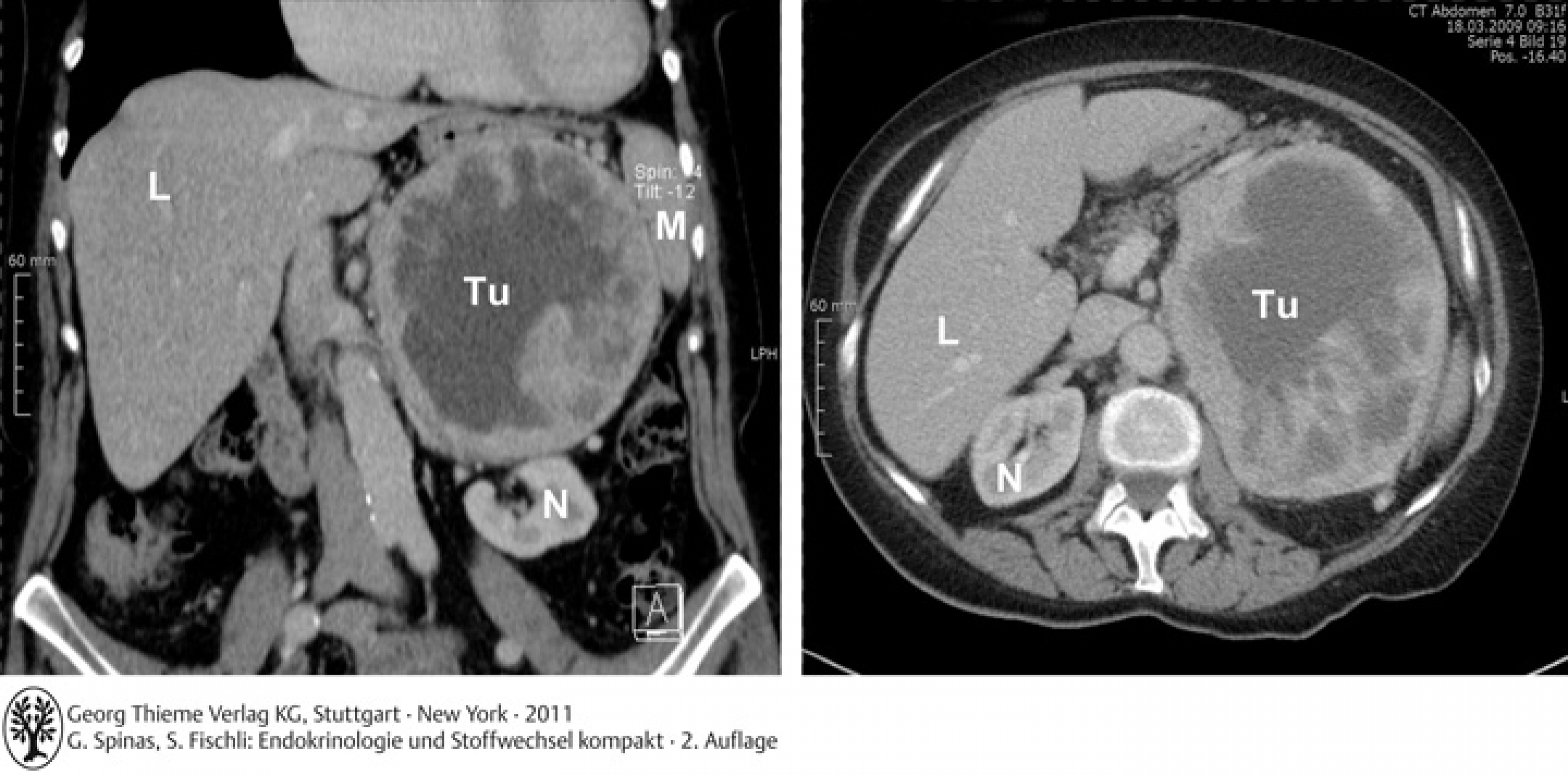 CT-Abdomen koronar und axial. Phäochromozytom (TU) von der linken Nebenniere ausgehend, Niere (N) und Milz (M) werden verdrängt.
