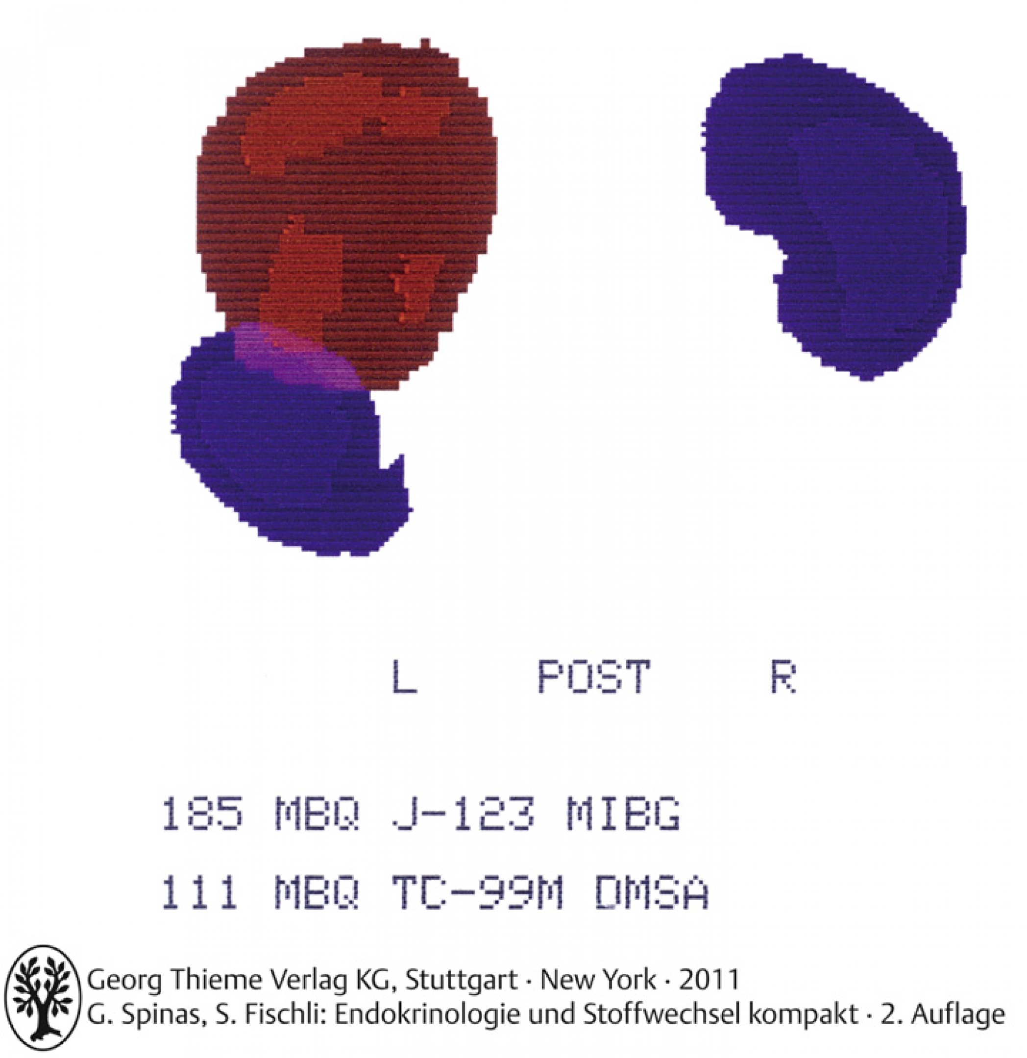 123 I-MIBG-Szintigrafie: Phäochromozytom links (rot)