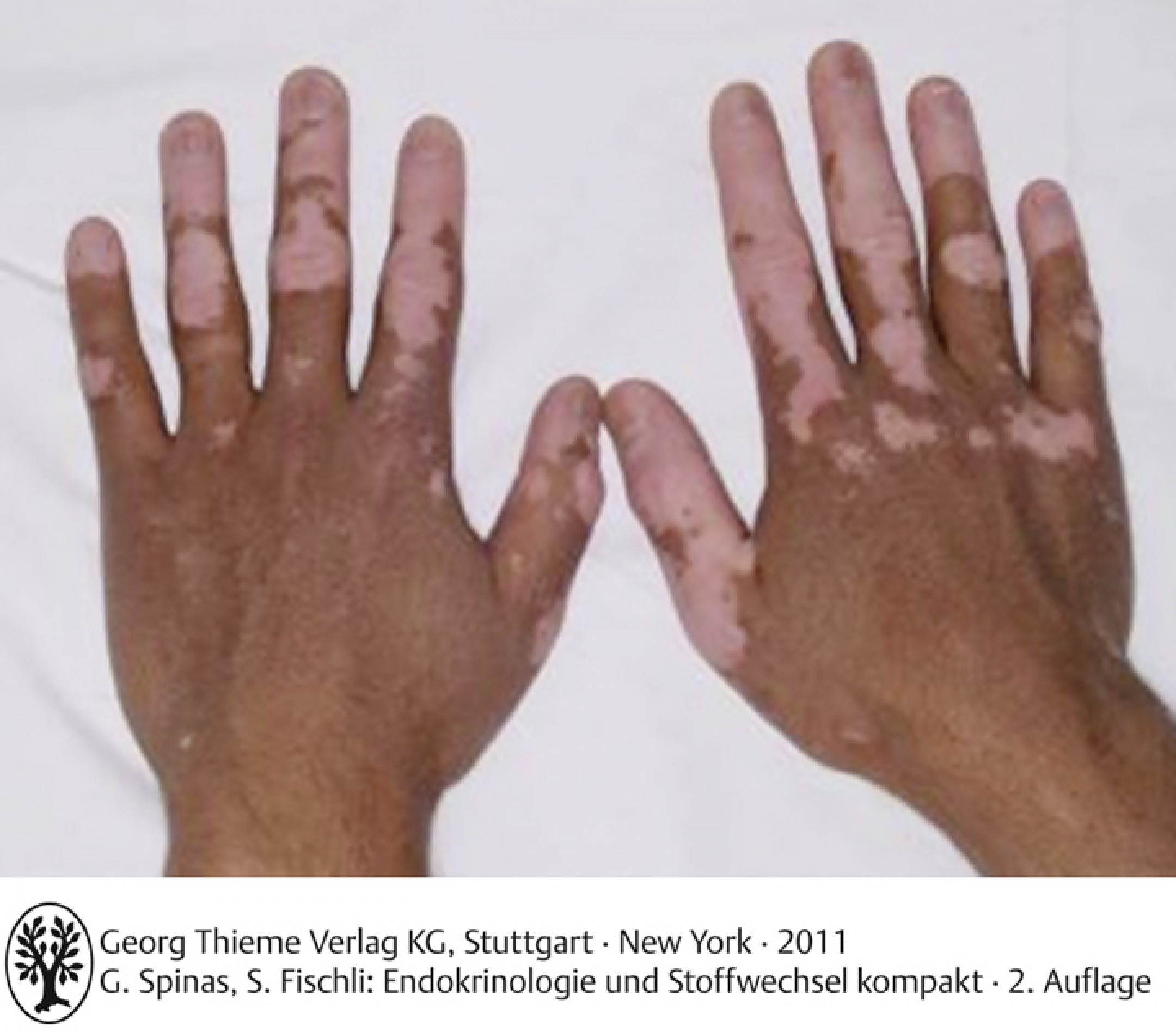 Vitiligo bei einem Patienten mit polyglandulärem Autoimmunsyndrom Typ II