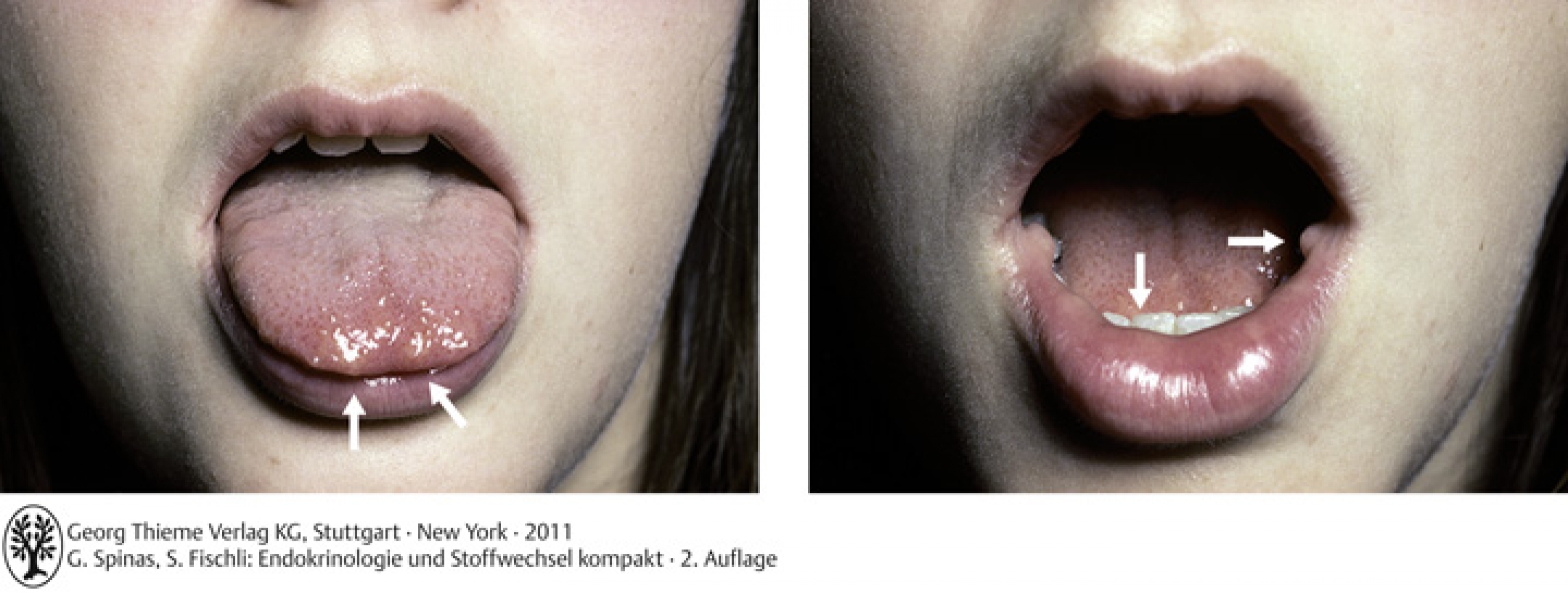 MEN 2B: Patient mit Neurinomen (siehe Pfeile) im Zungenbereich und an der Mundschleimhaut