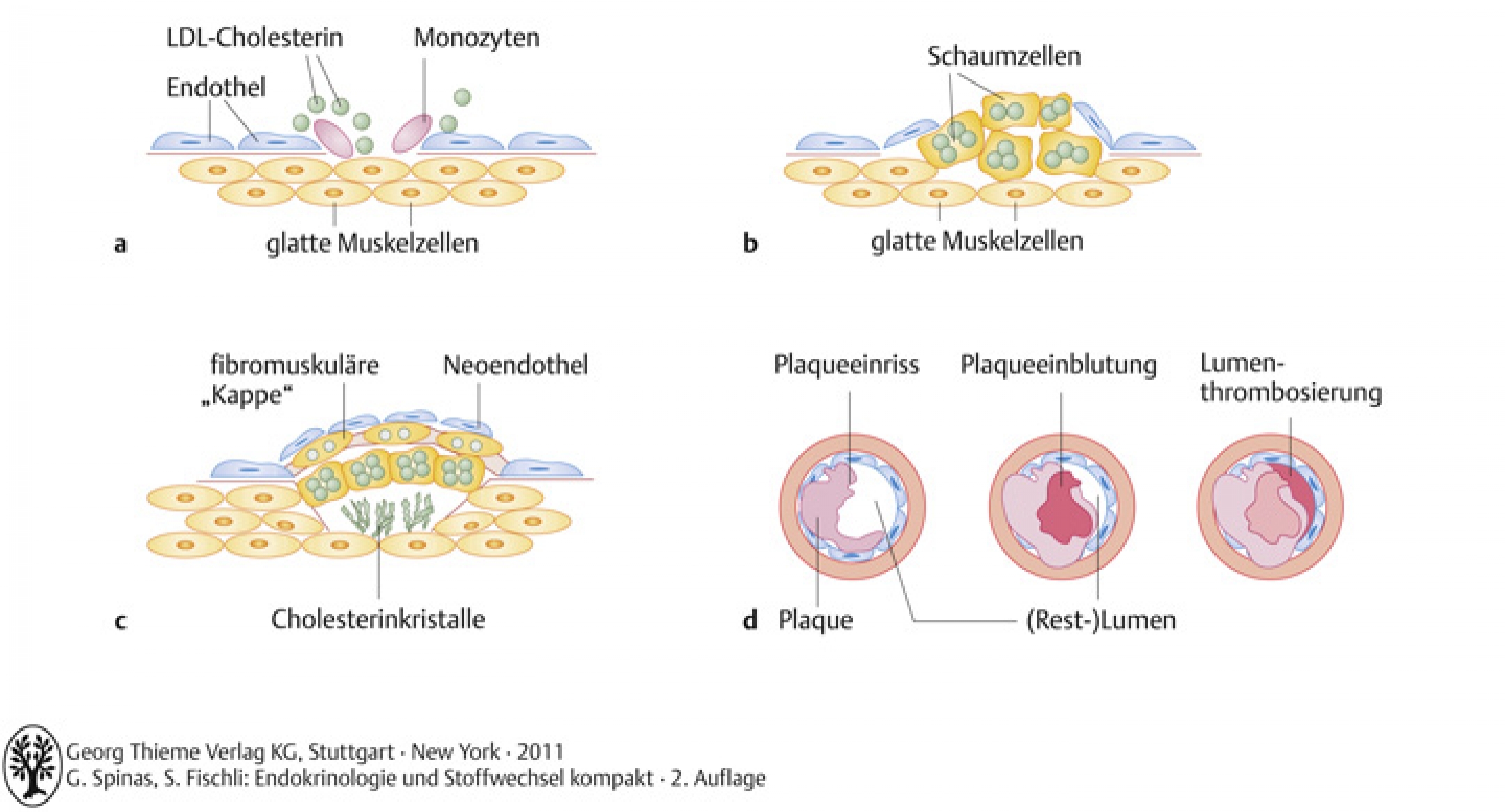 Pathogenese der Atherosklerose. a Endothelläsion, b Frühläsion, c Spätläsion, d Koronarverschluss