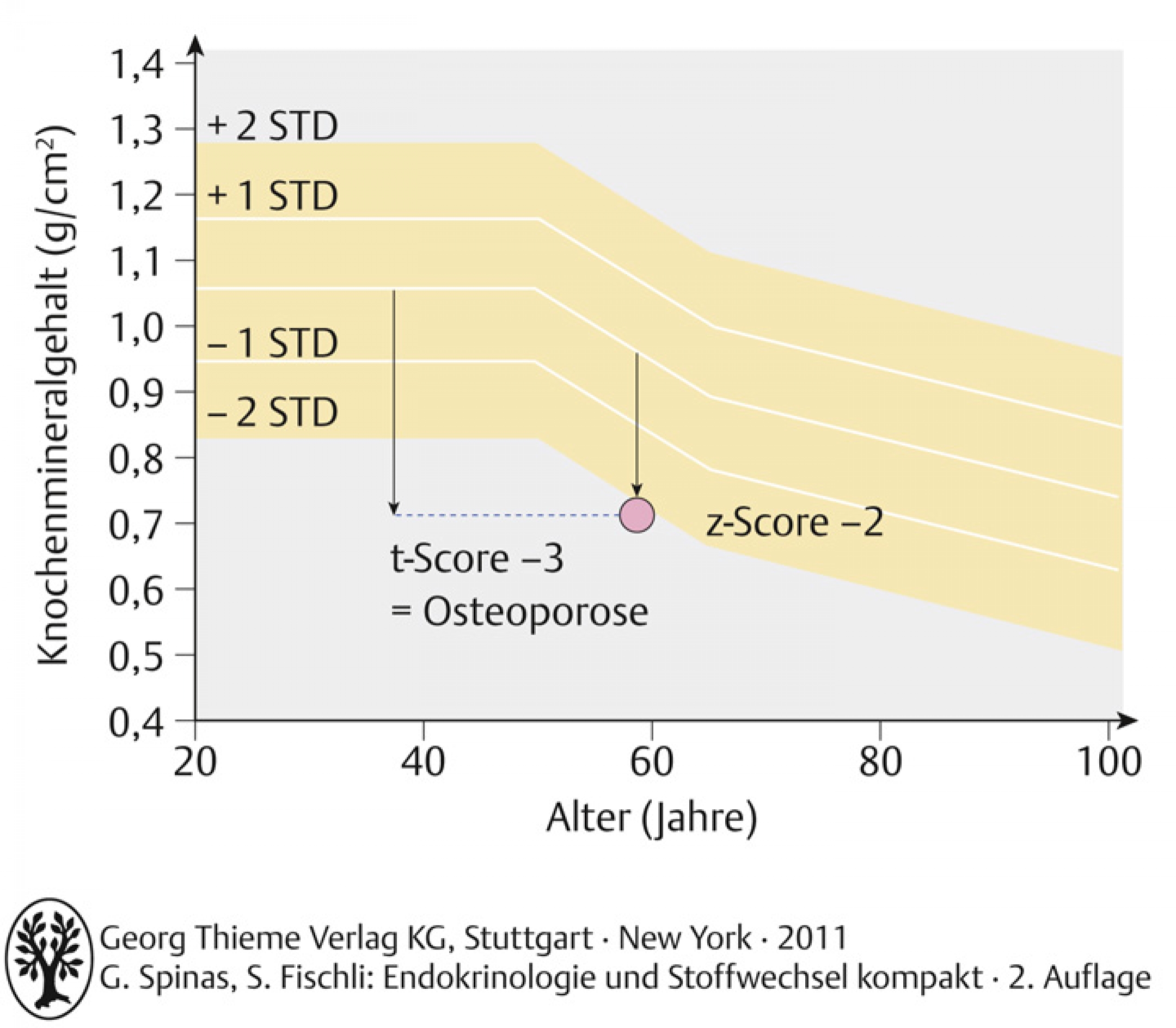 Densitometrieresultat einer 60-jährigen Patientin. Das Messresultat liegt 2 Standardabweichungen (STD) unter dem altersentsprechenden Referenzwert (z-Score: -2 SD). Im Vergleich mit prämenopausalen Frauen liegt der Messwert 3 SD unterhalb des Referenzwertes (t-Score: - 3 SD= Osteoporose).