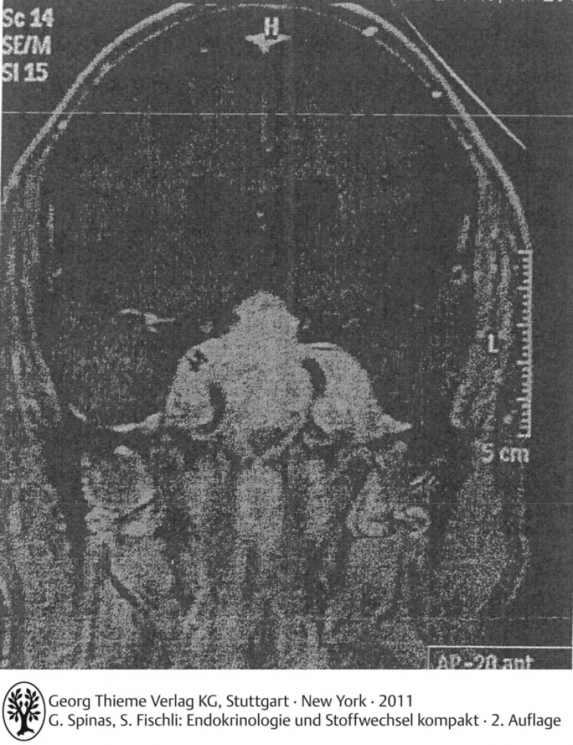 MRT der Hypophyse T1-gewichtetes koronares MRT mit Darstellung eines grossen suparsellären Hypophysenadenomes