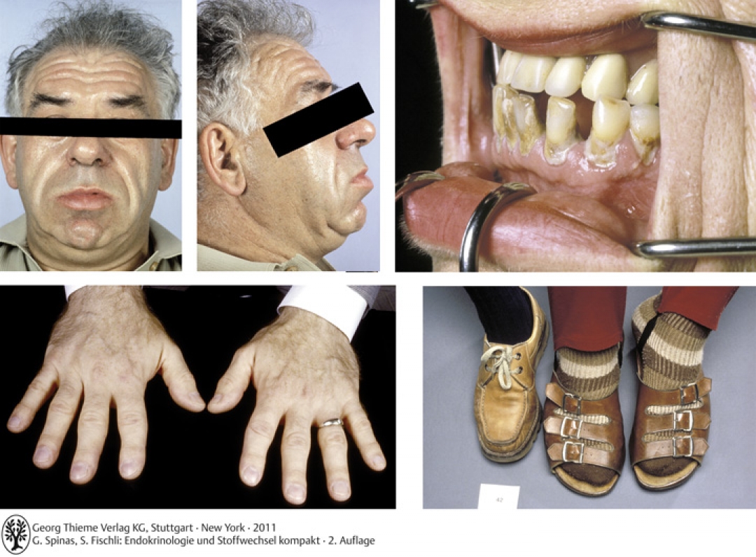 Typische klinische Veränderungen bei Akromegalie. Obere Reihe: Veränderungen von Gesicht und Zähnen; unten links: Vergösserung der Hände und Finger; unten rechts: Zunahme der Schuhgrösse.